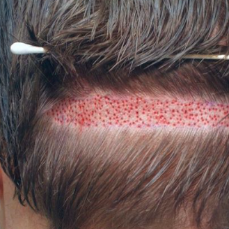 Hair Transplant   In Pakistan